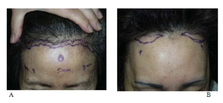 Hình 13-13 A, Nâng trán trước đường chân tóc là một biện pháp thay thế cho cách nâng trán cổ điển với 4 lỗ nội soi. Lượng da trán cần nâng được đánh dấu. Đường rạch được tạo zigzag để che sẹo hậu phẫu. B, Đường rạch trước chân tóc cải biên. Đường rạch tránh đường giữa nơi bệnh nhân thường rẽ tóc khi chải