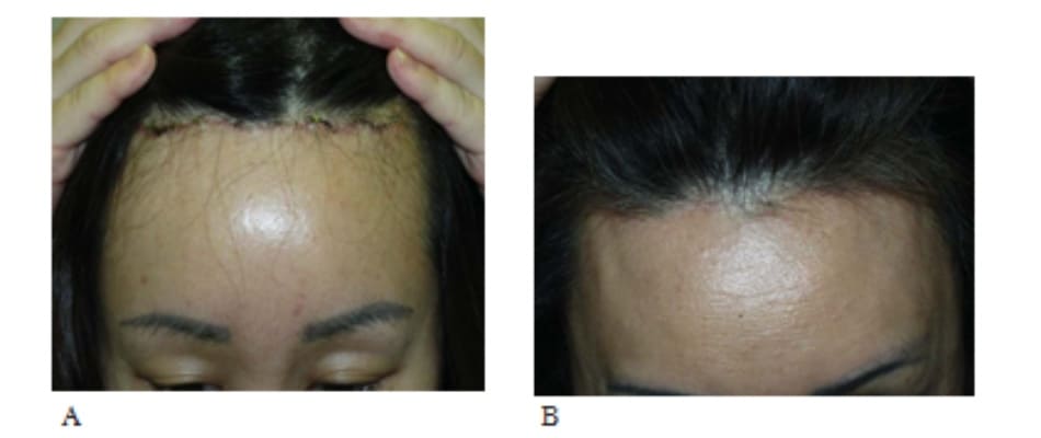 Hình 13-16 A, Ngay sau phẫu thuật. B, Sẹo hậu phẫu thuật khó thấy do tóc mọc che sẹo