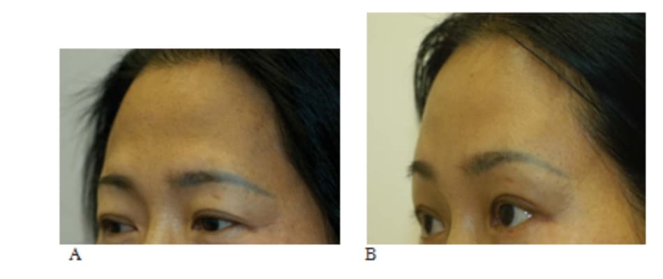 Hình 13-18 A, Hình ảnh tiền phẫu cho thấy nặng mí trên. B, hình ảnh hậu phẫu cho thấy hình ảnh khác biệt khi cung mày được nâng và yên vị phía trên rãnh trên ổ mắt.
