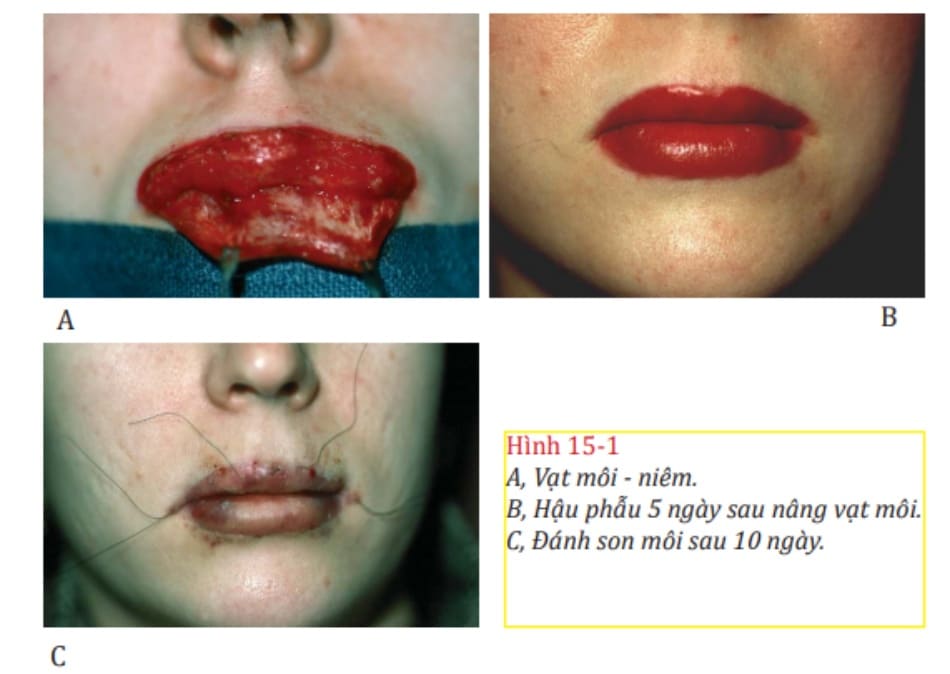 Hình 15-1 A, Vạt môi – niêm. B, Hậu phẫu 5 ngày sau nâng vạt môi. C, Đánh son môi sau 10 ngày